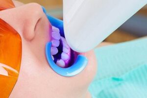 سفید کردن دندان در مطب - تکنودندان