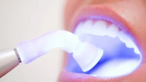 سفیدی دندان- تکنودندان