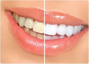  سفید کردن دندان - تکنودندان